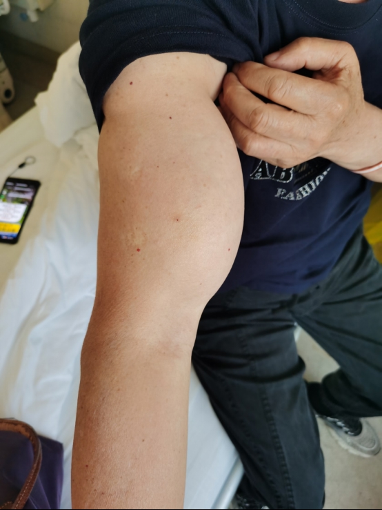 策略操盘 “麒麟臂”竟是体积巨大的脂肪瘤！医生提醒：这种情况不可掉以轻心